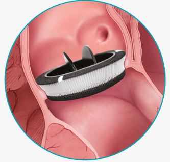 Carbomedics аортальный клапан