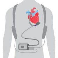 HeartMate 3™ LVAD system - THE IMPLANT REGISTER