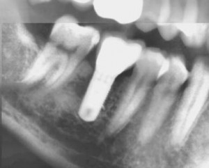 dental implant 46 01