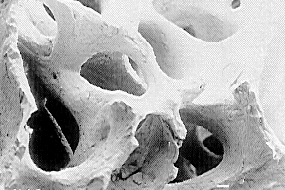 dental implant bone 04 Bio-Oss