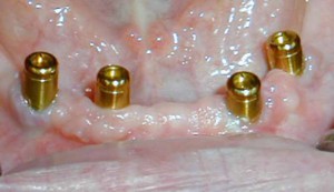 dental implant denture fix 01