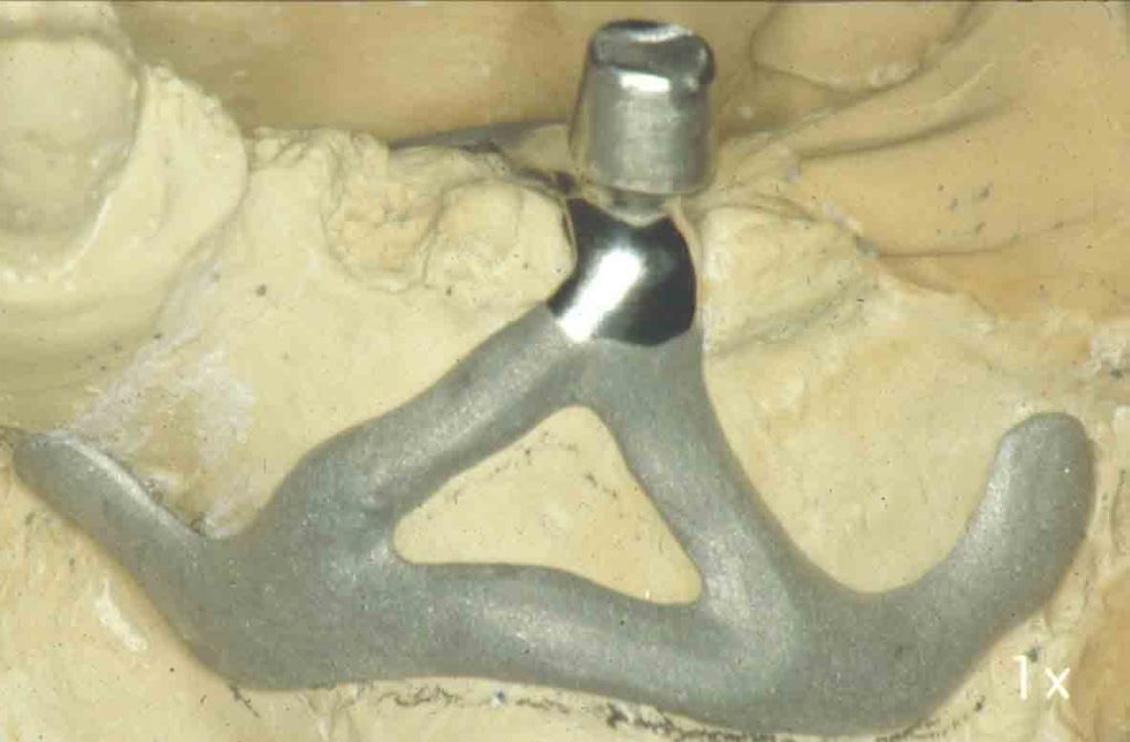 Dental subperiosteal implant THE IMPLANT REGISTER