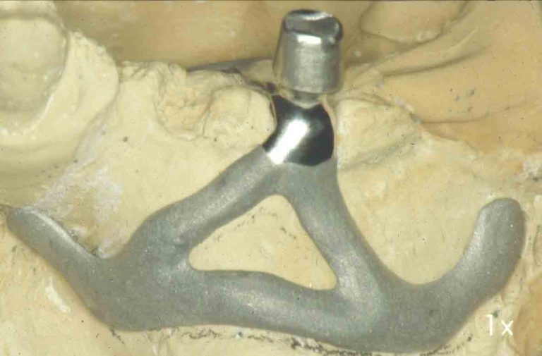 Dental subperiosteal implant THE IMPLANT REGISTER