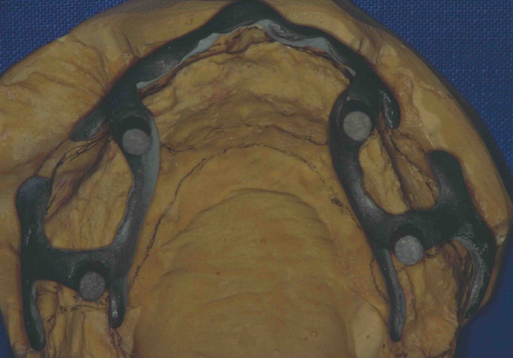 Dental subperiosteal implant THE IMPLANT REGISTER