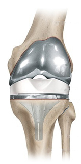 knee endoprosthesis